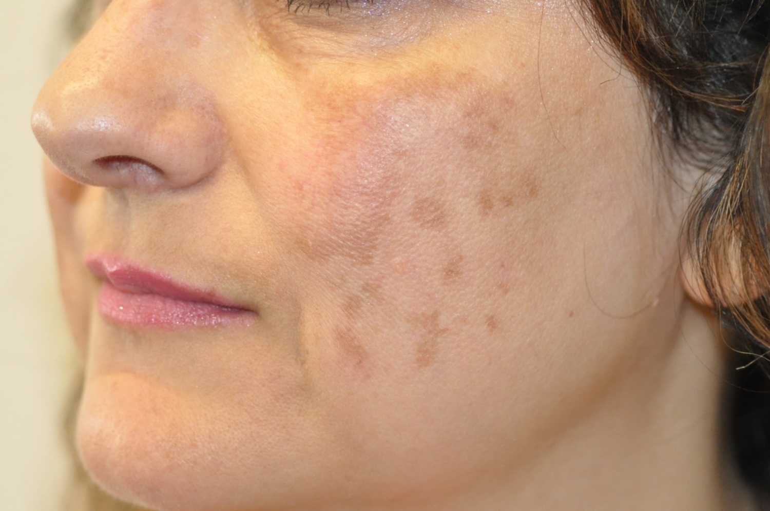 Age Spots, Brown or Red Spots Treatment in Crown Point IN